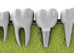 Dental Implants