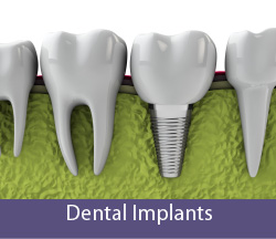 Implants Dentures