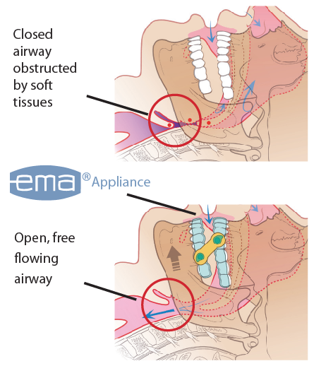 EMA before after